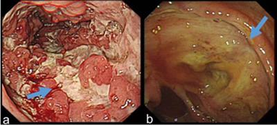 Differential Diagnosis of Crohn’s Disease and Ulcerative Primary Intestinal Lymphoma: A Scoring Model Based on a Multicenter Study